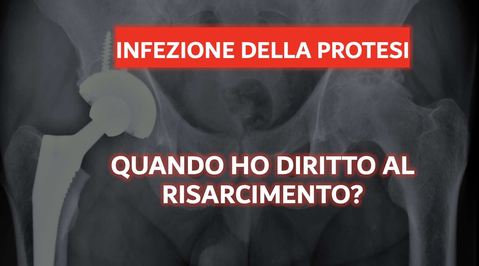 Risarcimento per infezione della protesi d'anca